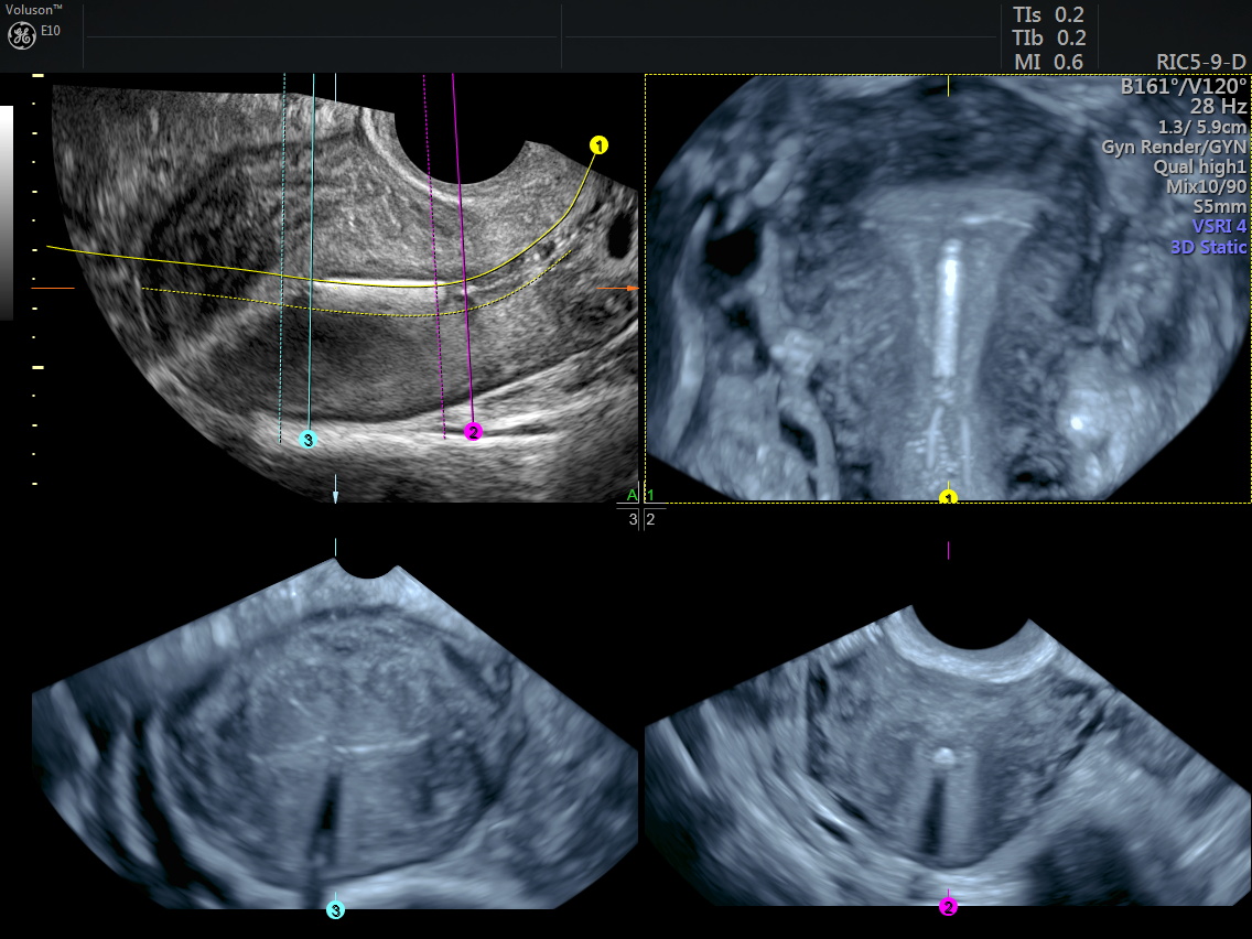Ultrassonografia 3d Em Ginecologia Diu Fort Imagem 7337